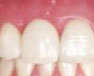 after_implant